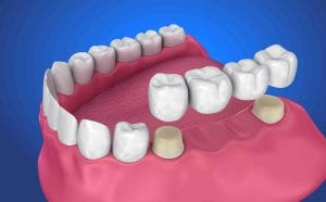 Dental Bridges Merrell and Nichols Dentistry dentist in Lubbock Texas Dr. P’Jay Merrell Dr. Kathleen Nichols