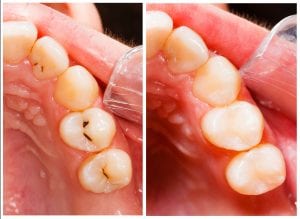 Best Dentist in Lubbock, TX Top Rated Lubbock Dentist Composite Fillings Merrell and Nichols Dentistry dentist in Lubbock Texas Dr. P’Jay Merrell Dr. Kathleen Nichols