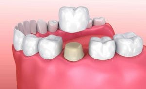 Best Dentist in Lubbock, TX Top Rated Lubbock Dentist Dental Crowns Merrell and Nichols Dentistry dentist in Lubbock Texas Dr. P’Jay Merrell Dr. Kathleen Nichols