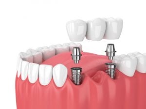 implant supported bridge Best Dentist in Lubbock, TX Top Rated Lubbock Dentist Teeth Whitening Lubbock Dr. P’Jay Merrell Dr. Kathleen Nichols Merrell and Nichols Dentistry General, Cosmetic, Restorative, Preventative Family Dentist in Lubbock, TX 79423 porcelain veneers merrell dental Dr. P'jay Merrel top Rated Prosthodontist in Lubbock Texas Dr. Kathleen Nichols Best Prosthodontist in Lubbock services contact us
