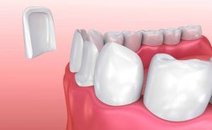 porcelain veneers merrell dental Dr. P'jay Merrel top Rated Prosthodontist in Lubbock Texas Dr. Kathleen Nichols Best Prosthodontist in Lubbock services contact us
