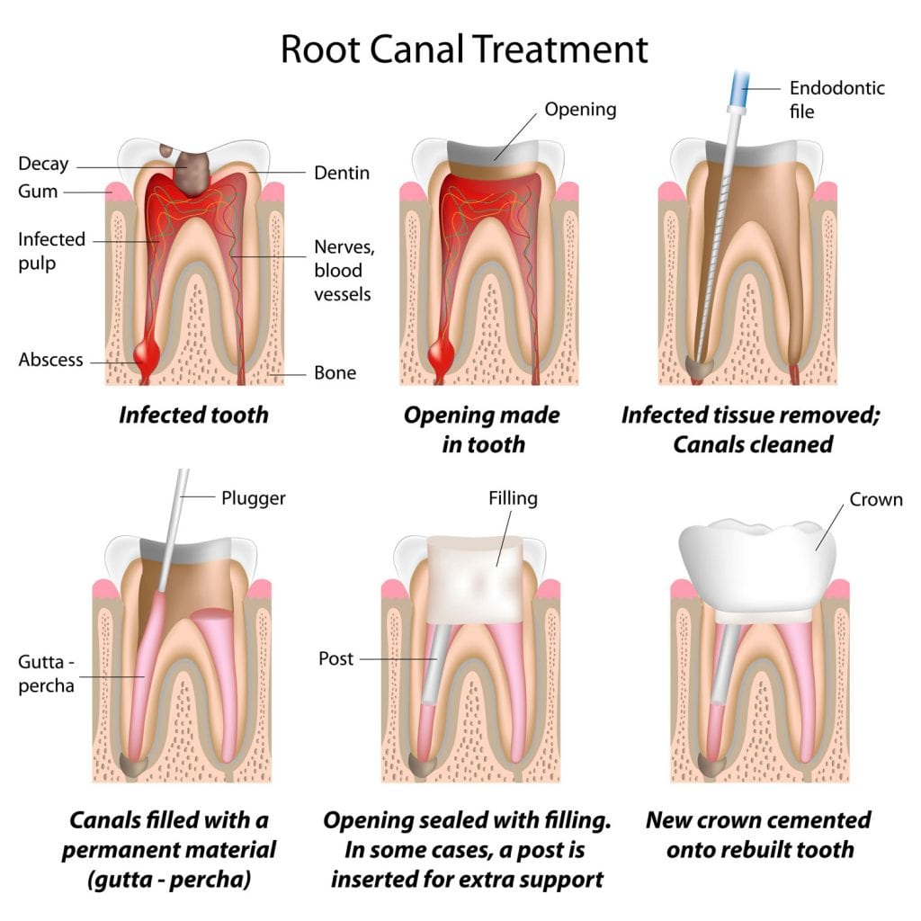 Best Dentist in Lubbock, TX Top Rated Lubbock Dentist Root Canal Therapy Merrell and Nichols Dentistry dentist in Lubbock Texas Dr. P’Jay Merrell Dr. Kathleen Nichols